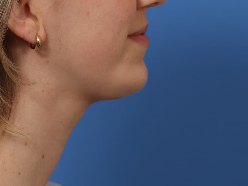 Chin–neck definition, after