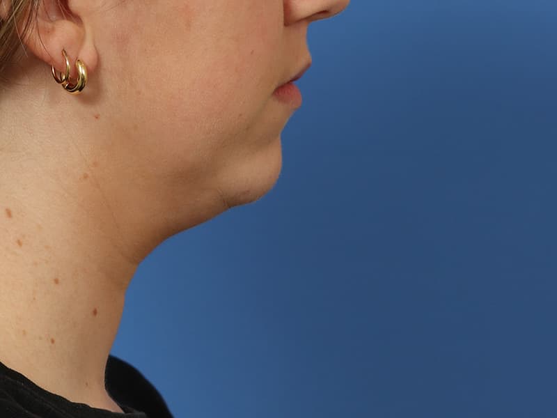 Chin–neck definition, before