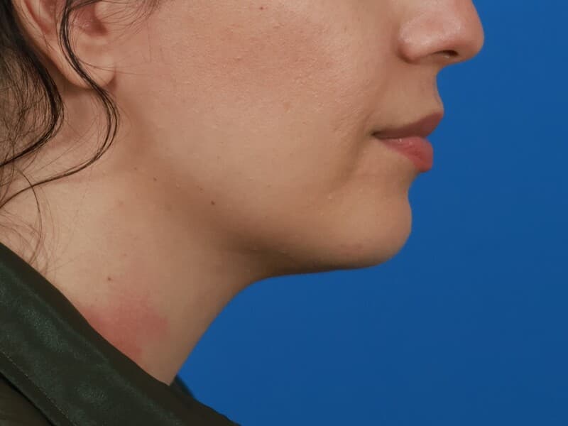 Renata chin enhancement patient, after