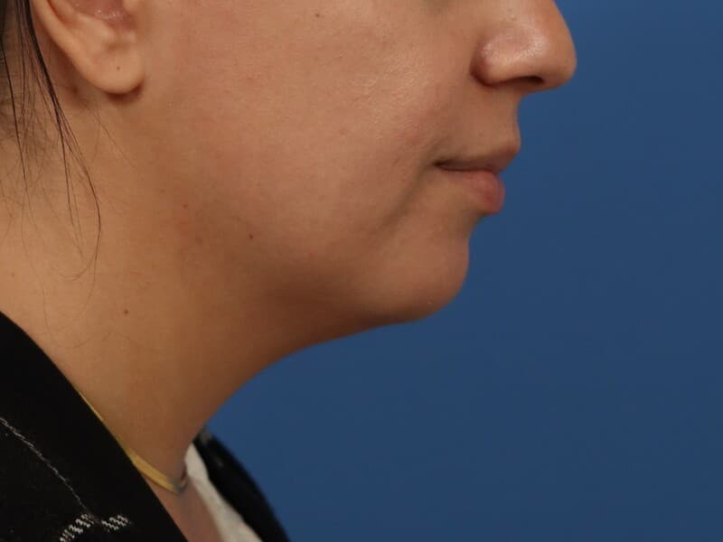 Renata chin enhancement patient, before