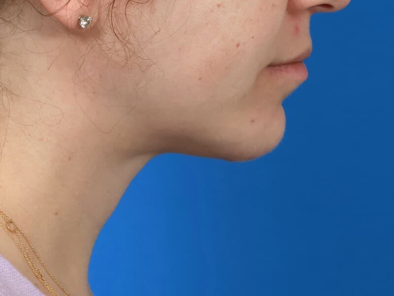 Lower-face proportion, after