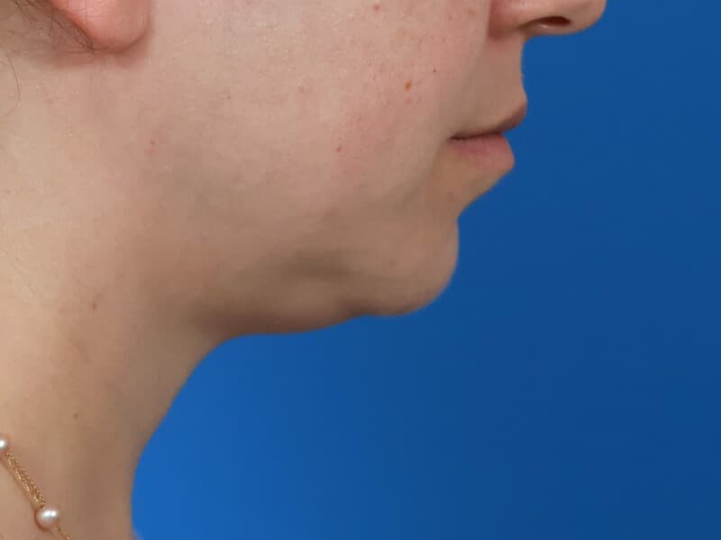 Lower-face proportion, before