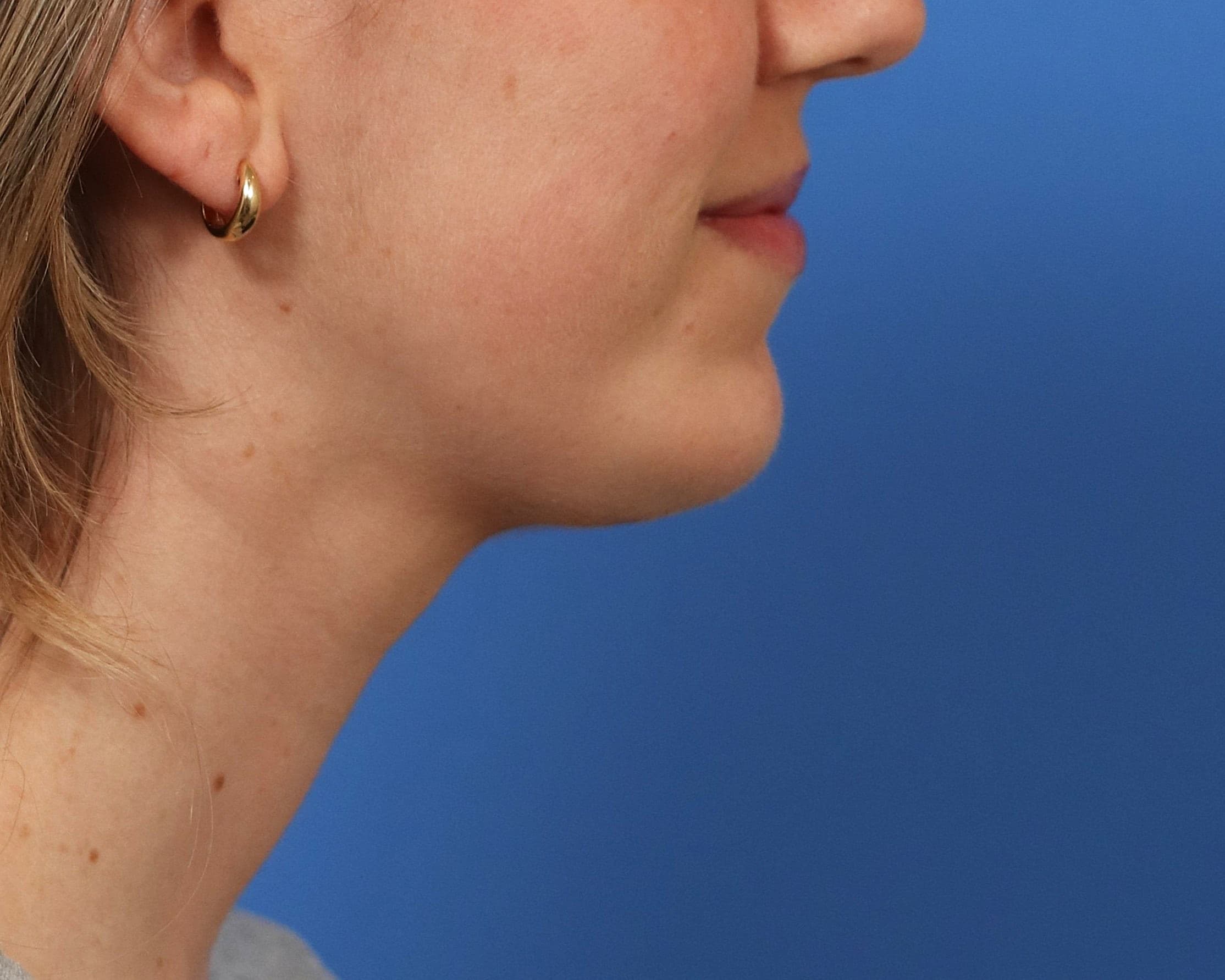 Patient profile six months after chin implant and neck liposuction