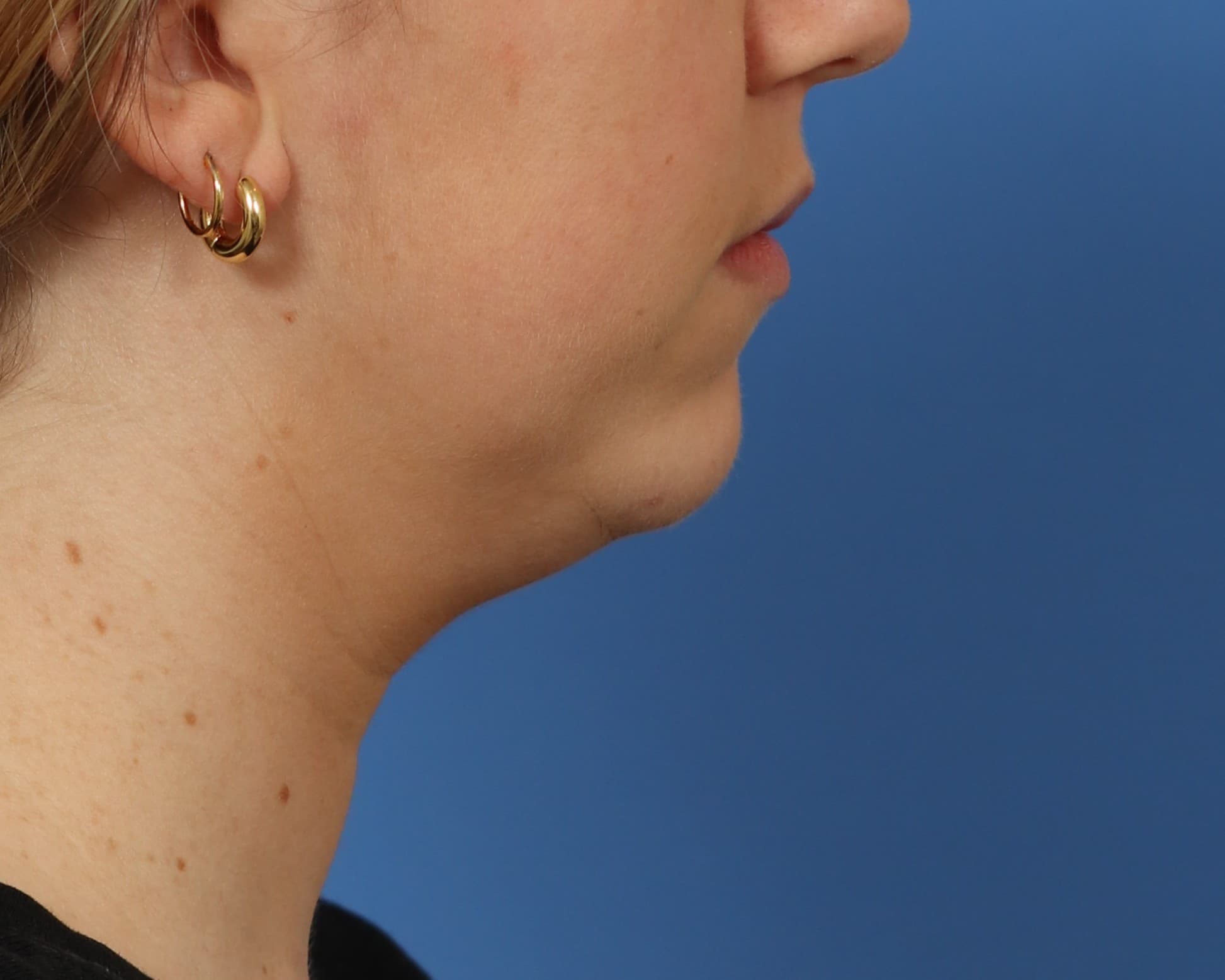 The same patient before chin implant and neck liposuction