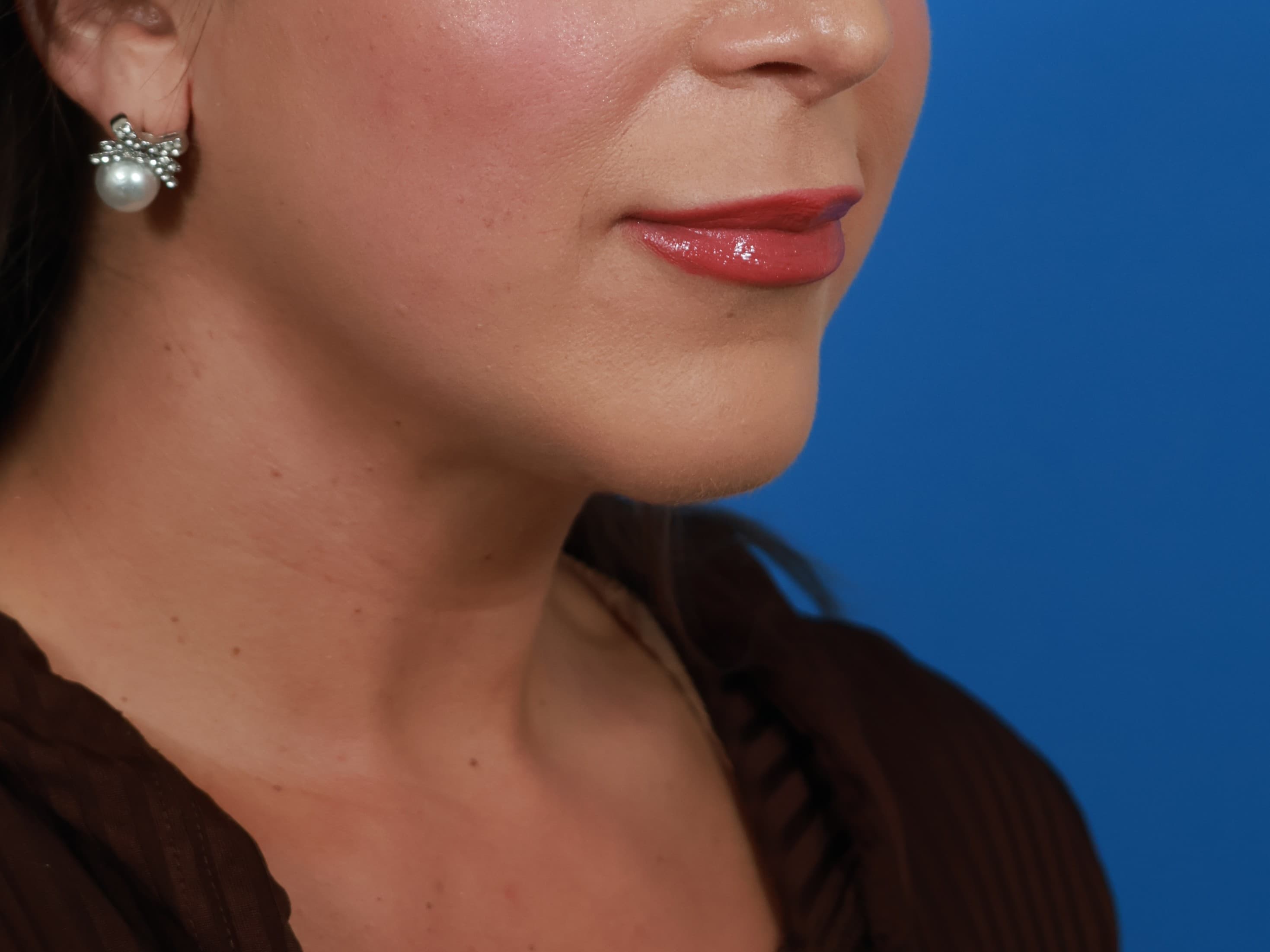 Case 04, profile, 2 months after surgery