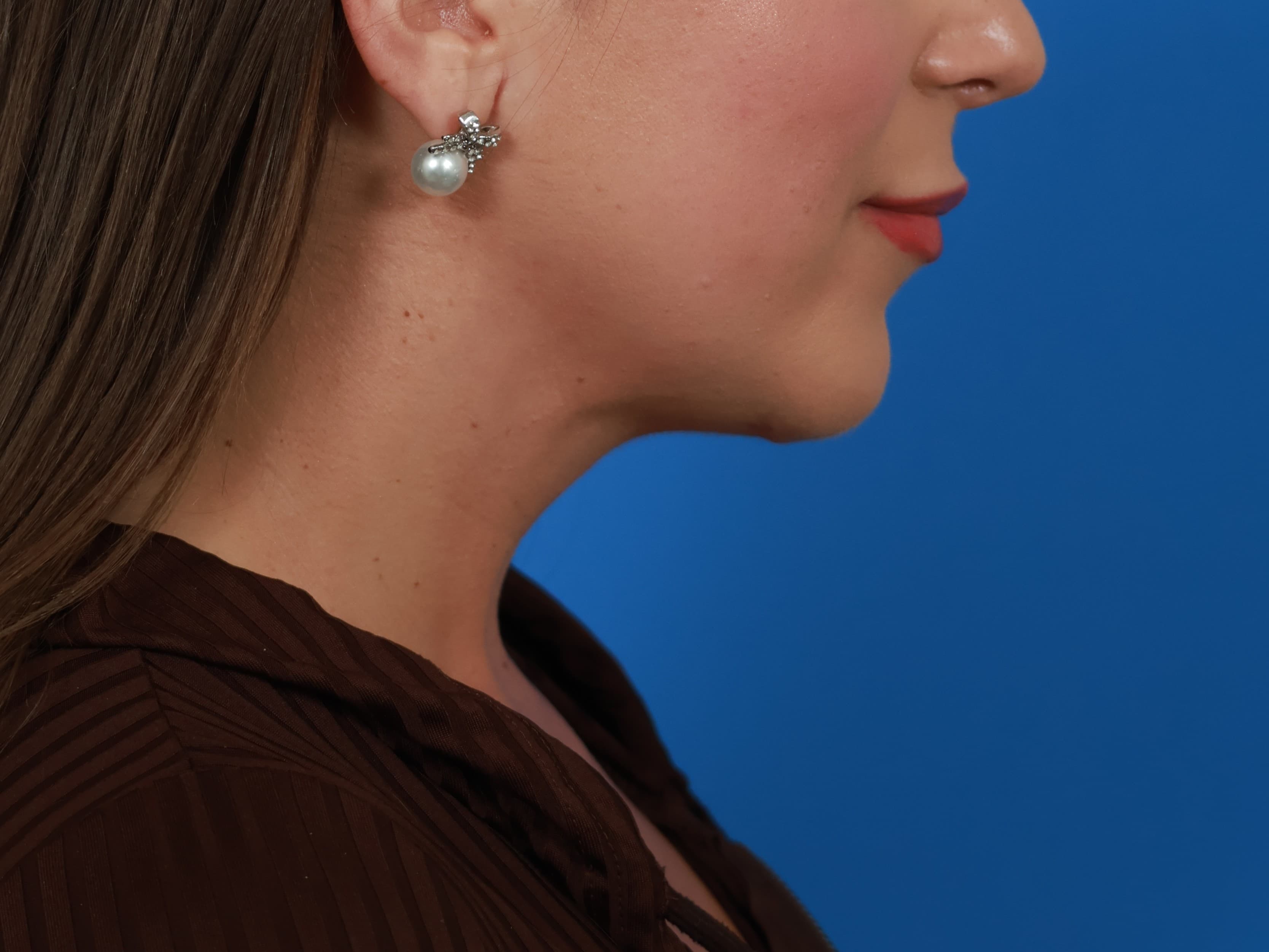 Case 04, three-quarter view, 2 months after surgery